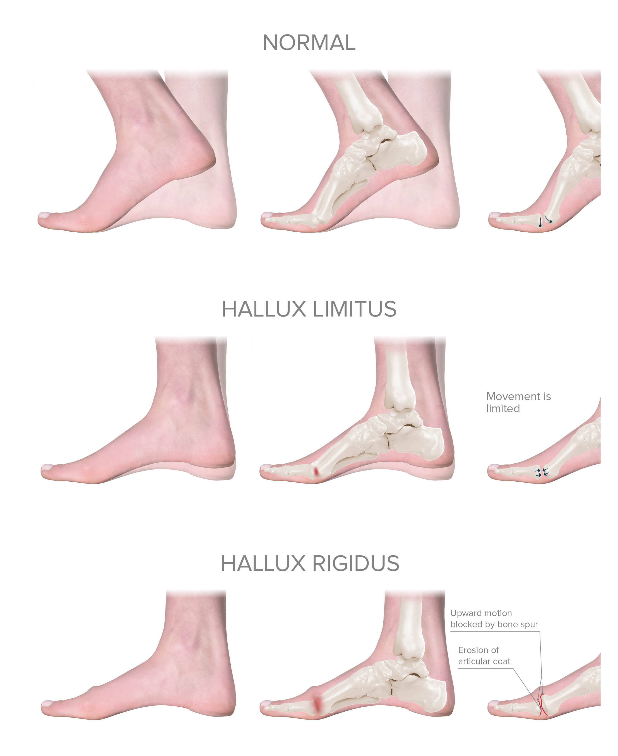 Hallux Rigidus