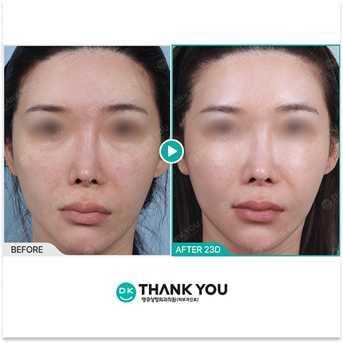 Rejuran Healer 4cc Skin Renewal Results Demonstrating Enhanced Hydration Smoother Texture and Radiant Complexion