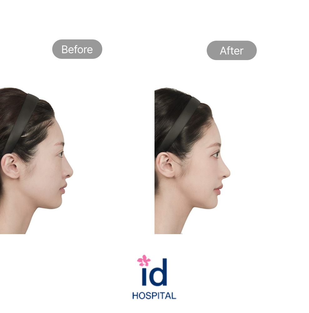 Female Revision Rhinoplasty Side View Before and After Result at ID Hospital