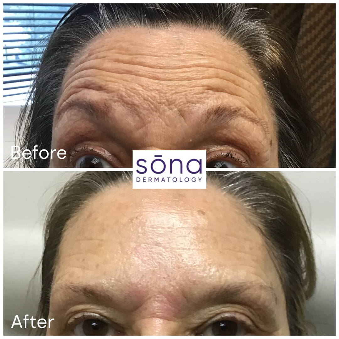 Sona - Botox Cosmetic Before & After 7