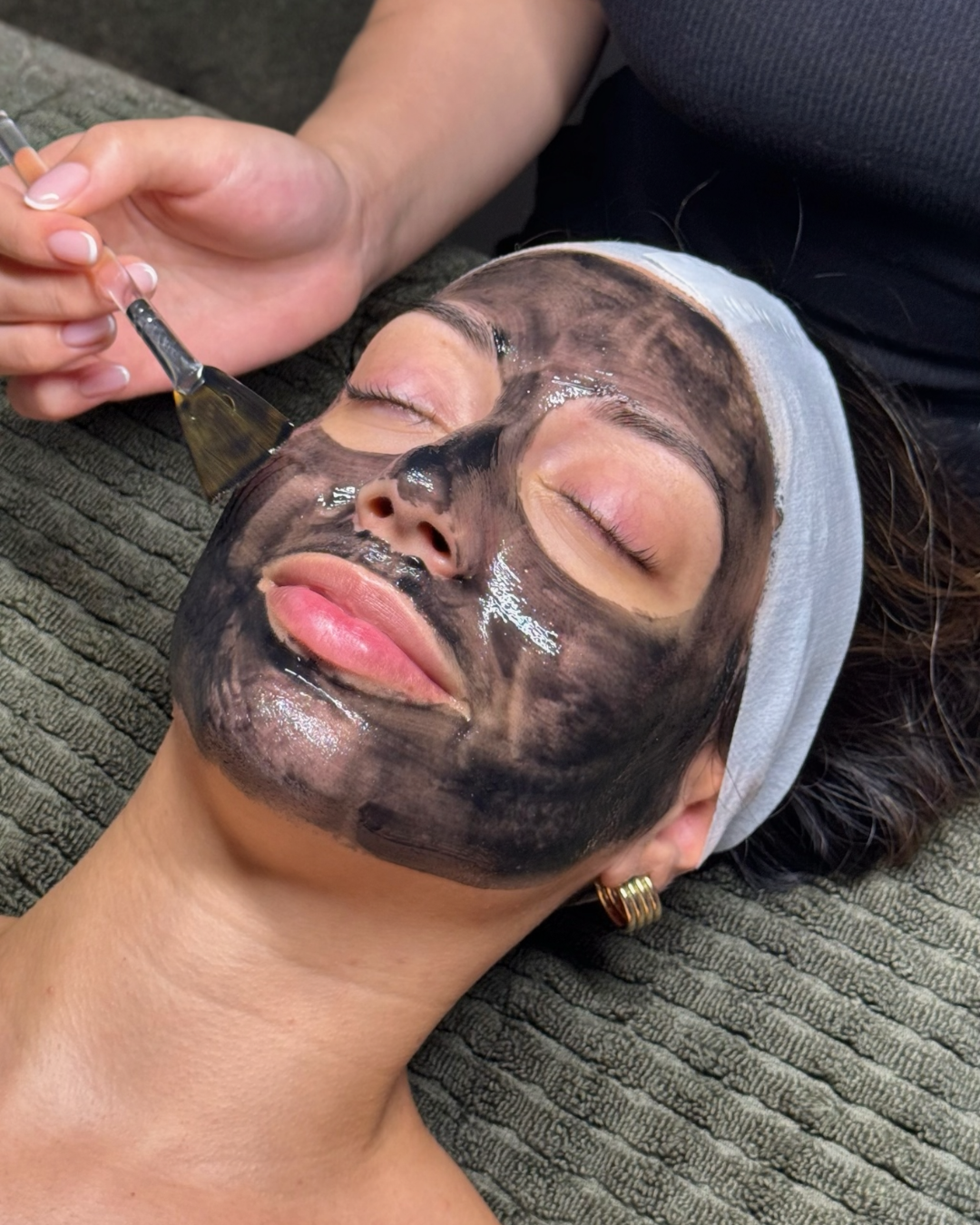 Dermal therapist performing microneedling for acne scars at Beauface Sydney