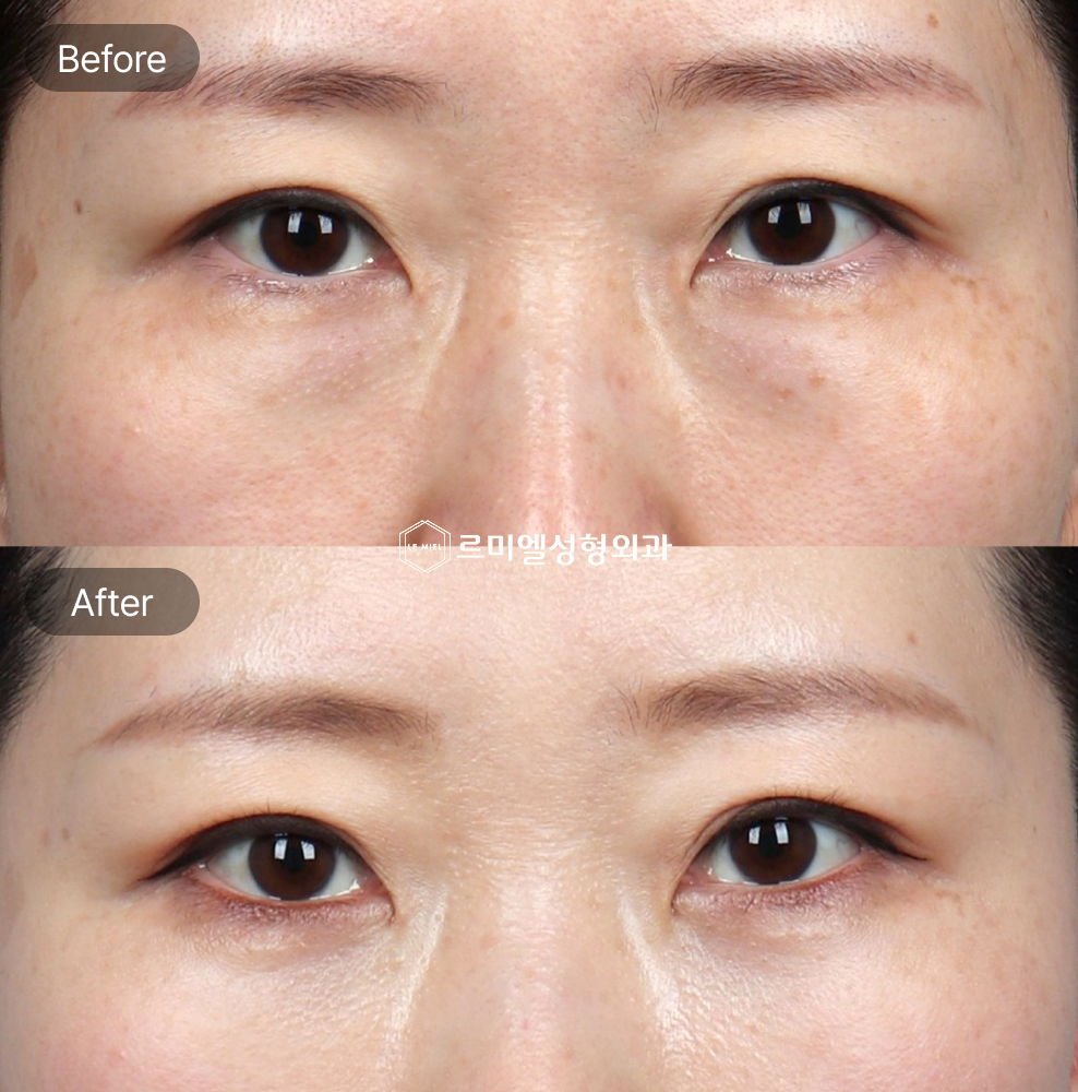Before and After Results of Under Eye Fat Repositioning and Virtue RF Treatment After Two Months