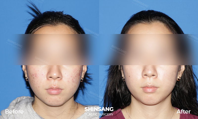 Acne Treatment Review And Result At Sinsang Plastic Surgery In Korea