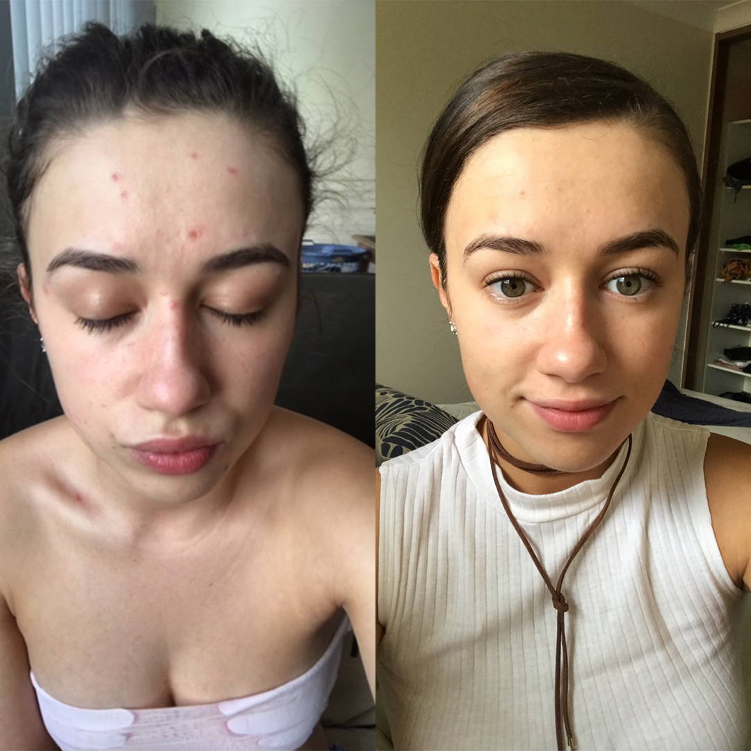 go to skincare acne