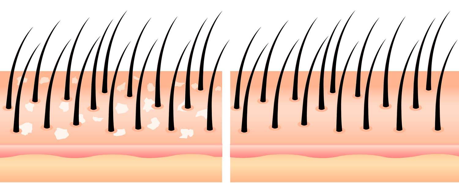 Illustration af skæl i hovedbunden versus en hovedbund uden skæl