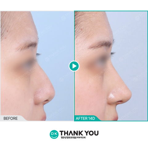 Plastic Surgery Recovery Timeline Explaining Swelling Stages and Tissue Healing Process After Surgery