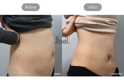 Core Sculpt Before And After Results At 4 Weeks Showing Noninvasive Body Fat Reduction In Korea
