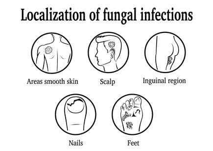 Infographie sur la localisation des infections fongiques