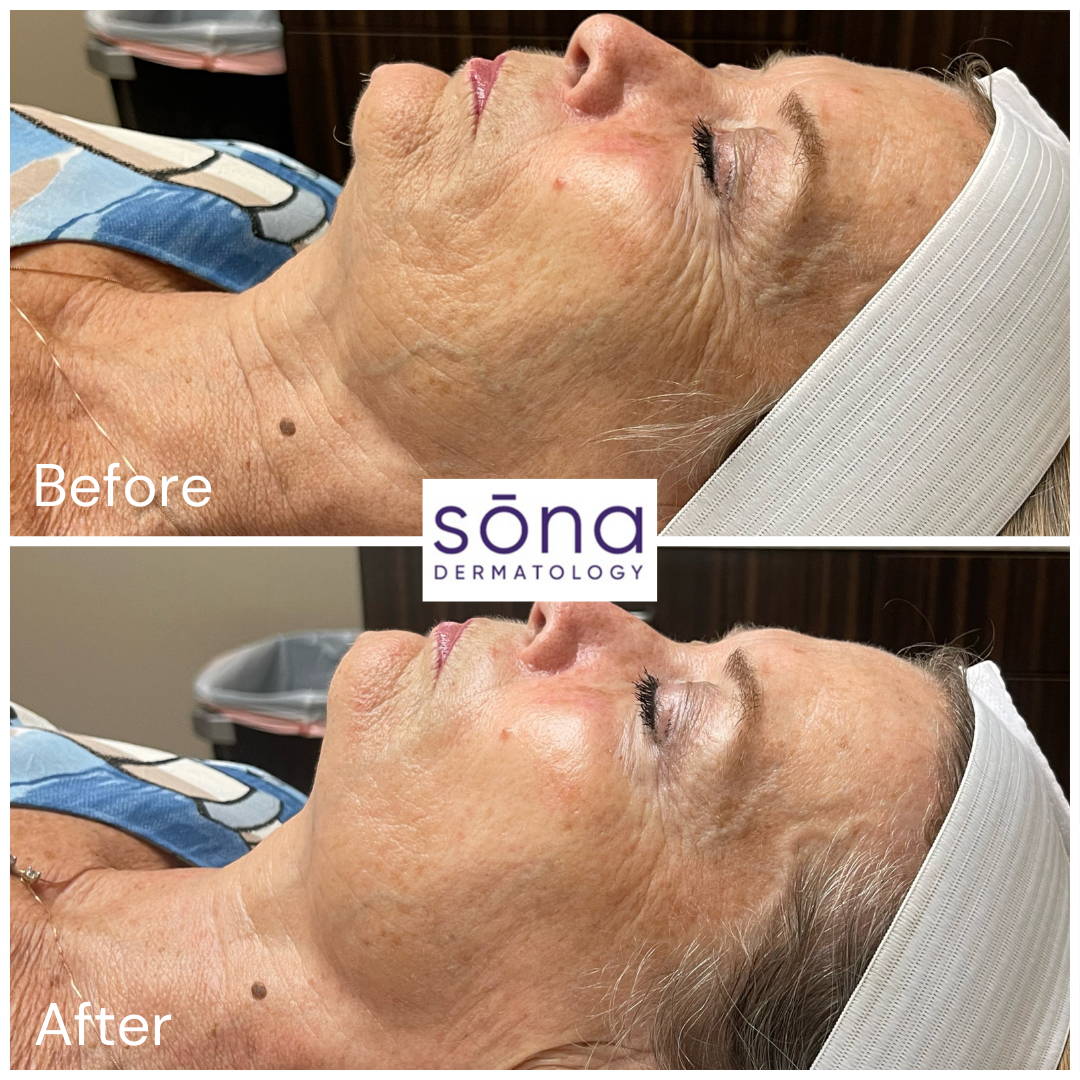 Sona DiamondGlow Facial Before & After 2