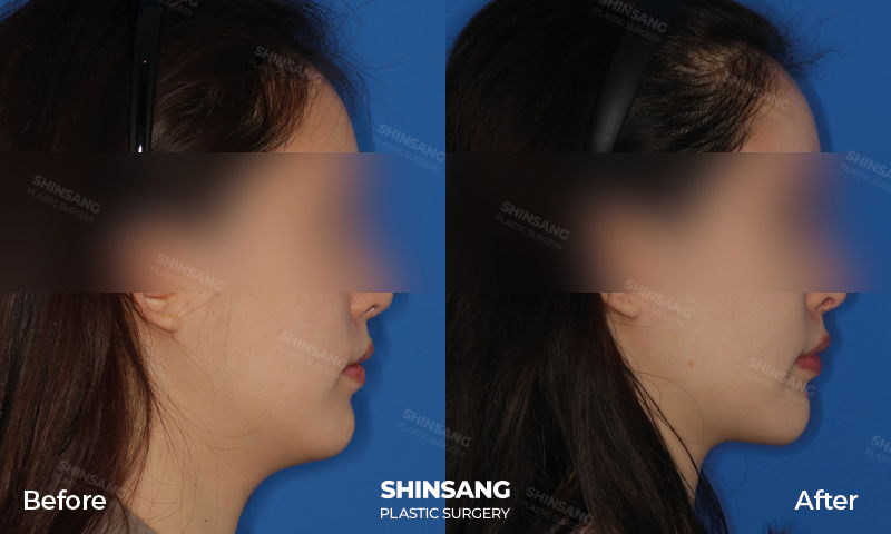 Pixel Injection And Tension Lifting Skin Tightening Result At Sinsang Plastic Surgery In Korea