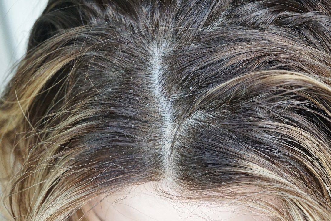 postpartum scalp psoriasis treatment