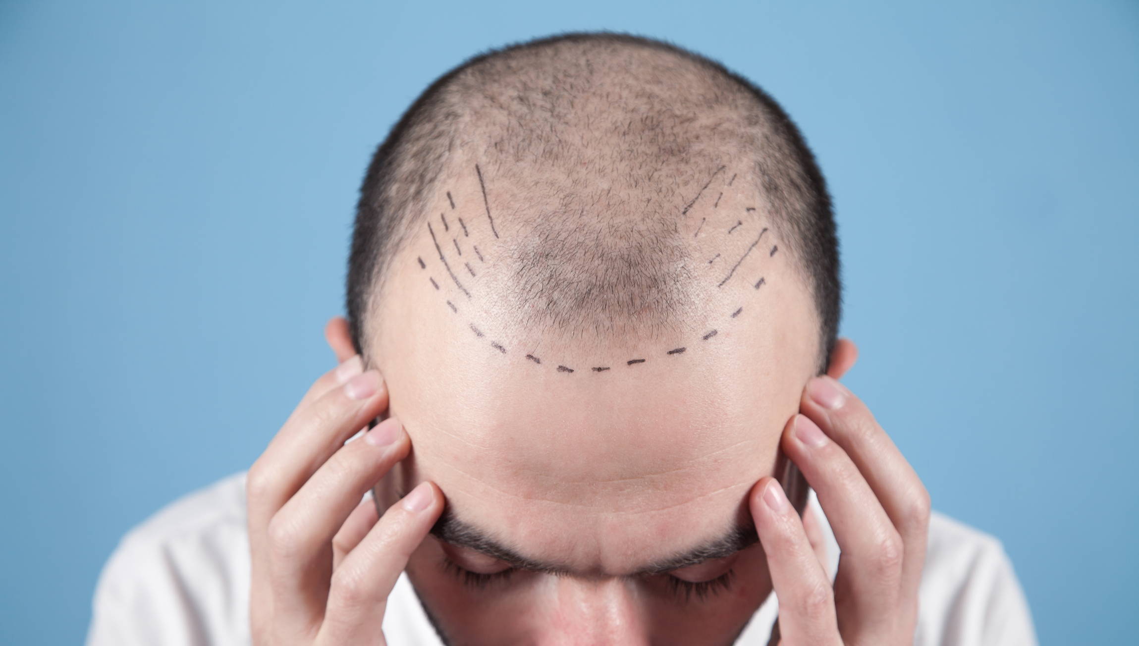 How to Sleep After an FUE Hair Transplant – DS Healthcare Group