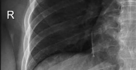 X-Ray of Pin in Lung