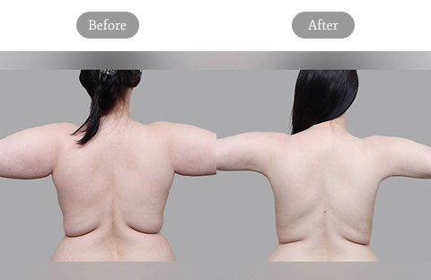Before And After Review Image Of Arm And Shoulder Liposuction At Girin Plastic Surgery Clinic In South Korea