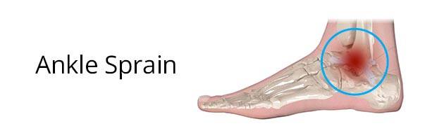 Ankle Sprain