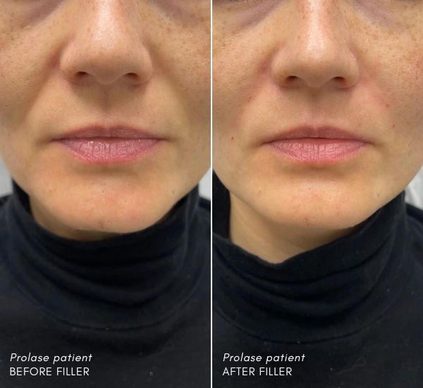 Prolase Patient before and after 1ml Vollure with Enesae Keshishian RN .