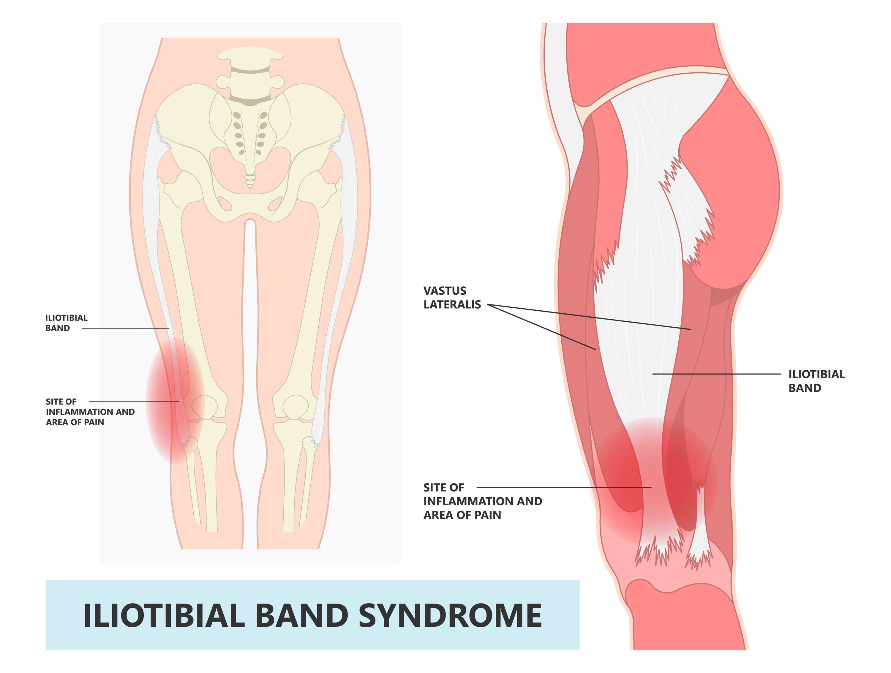 KT Tape Tutorial - IT Band  The IT Band, or iliotibial band, is a