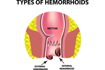 Image vectorielle de la différence entre les hémorroïdes internes et les hémorroïdes externes.