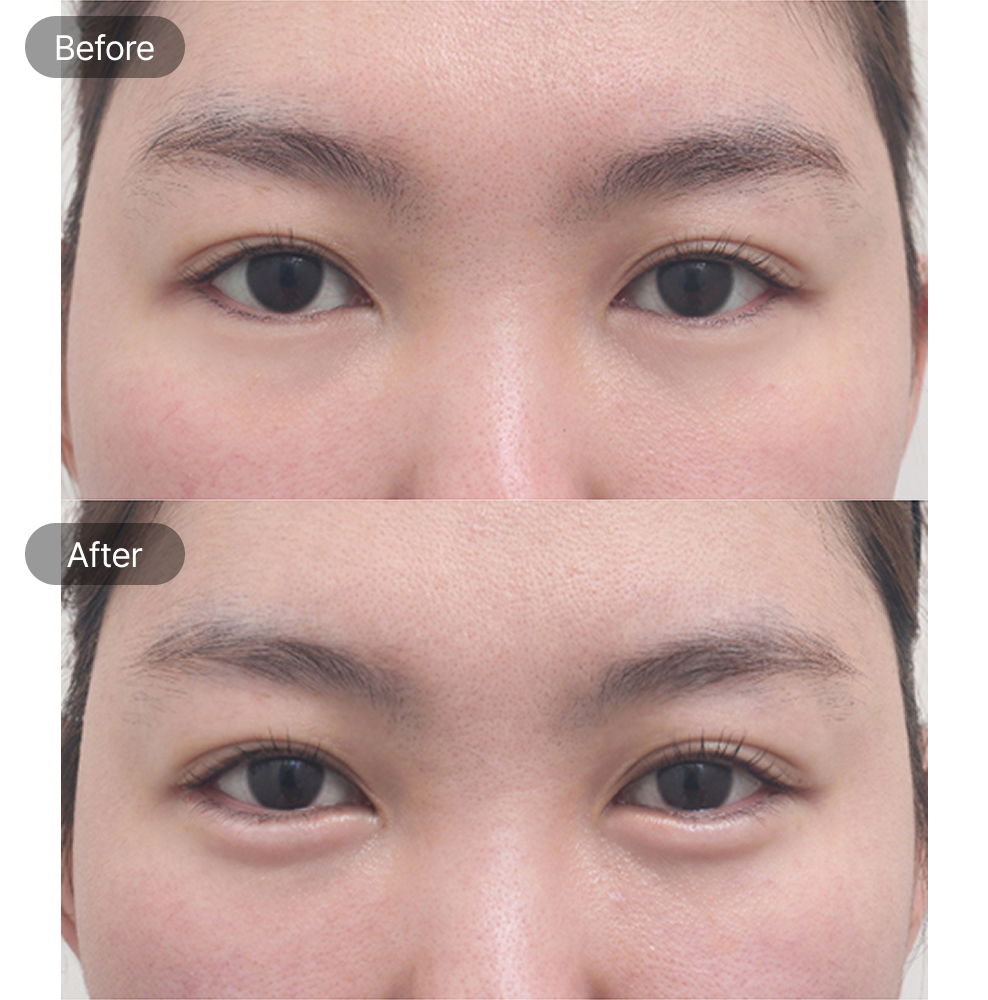 Eye rejuvenation before and after results for brighter under eye appearance at Fresh Dr. Hong in Korea