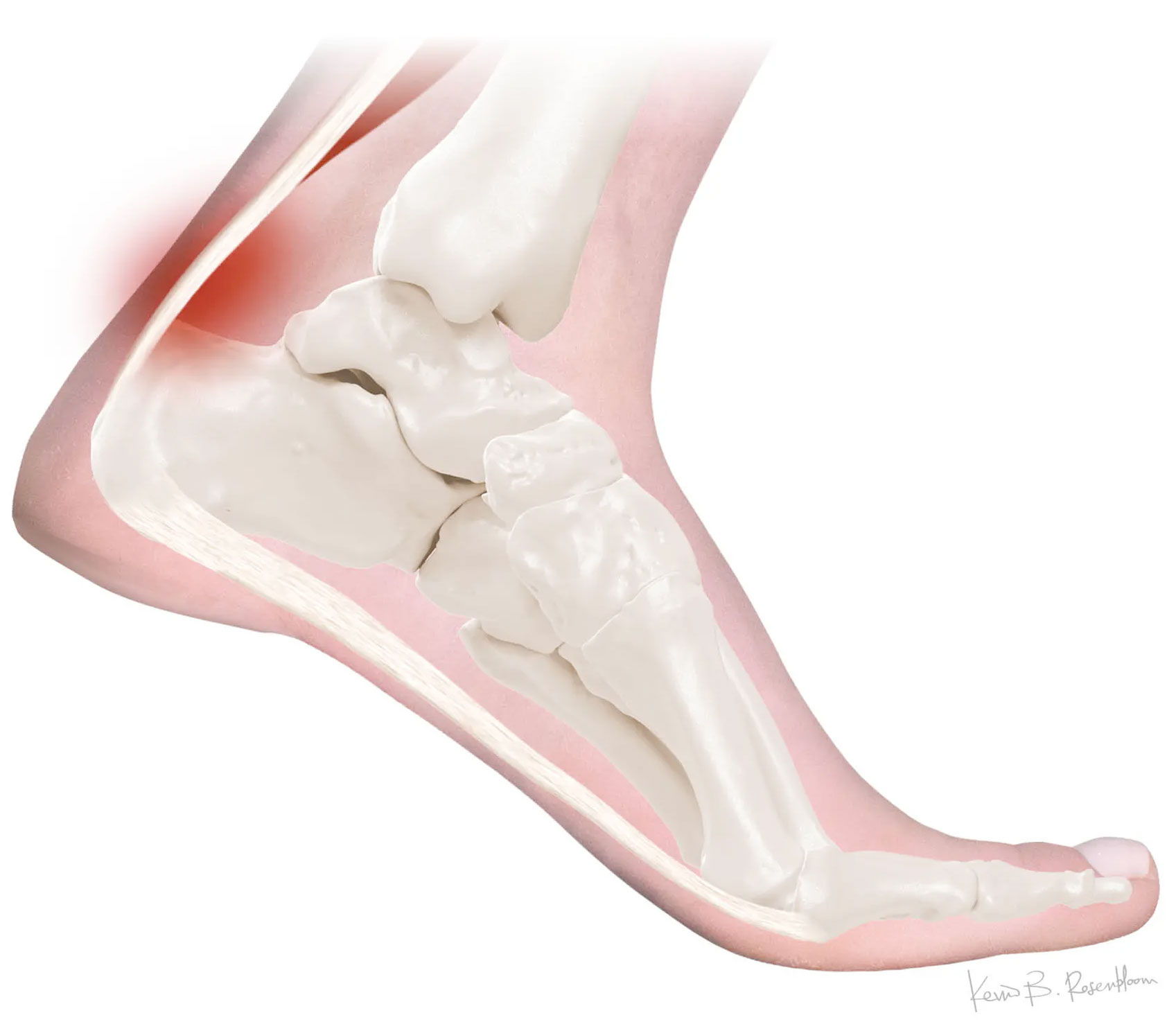 Achilles Tendinitis
