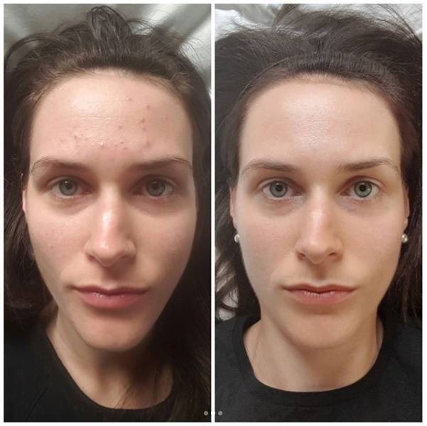 go to skincare acne