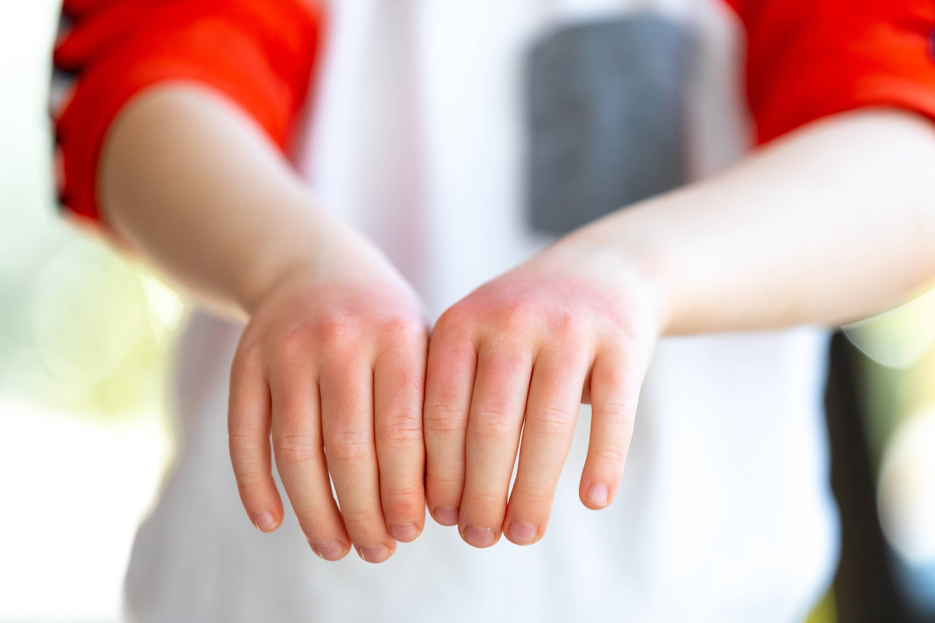 Een kind houdt rode en pijnlijke handen voor zich uit om te laten zien wat de klachten van contact huidallergie kunnen zijn.