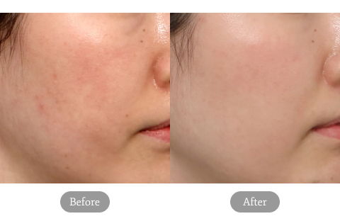Before And After Review Image Of Exosome Treatment At Jfeel Clinic