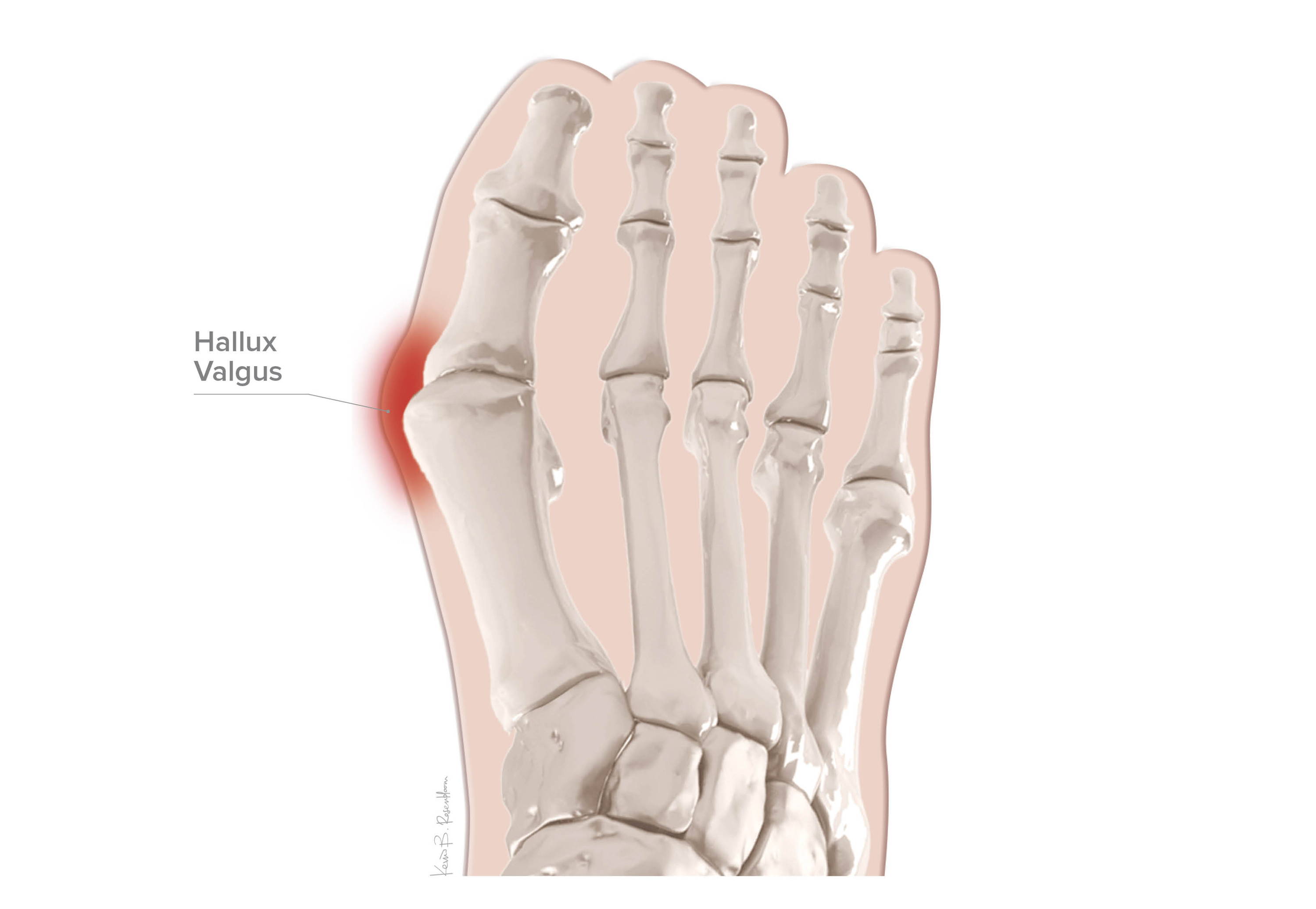 Hallux Valgus or Bunions