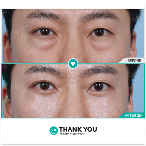 Male Plastic Surgery in Korea Featuring Natural Under Eye Rejuvenation, Male Rhinoplasty, Jawline Contouring, and Botox for Men