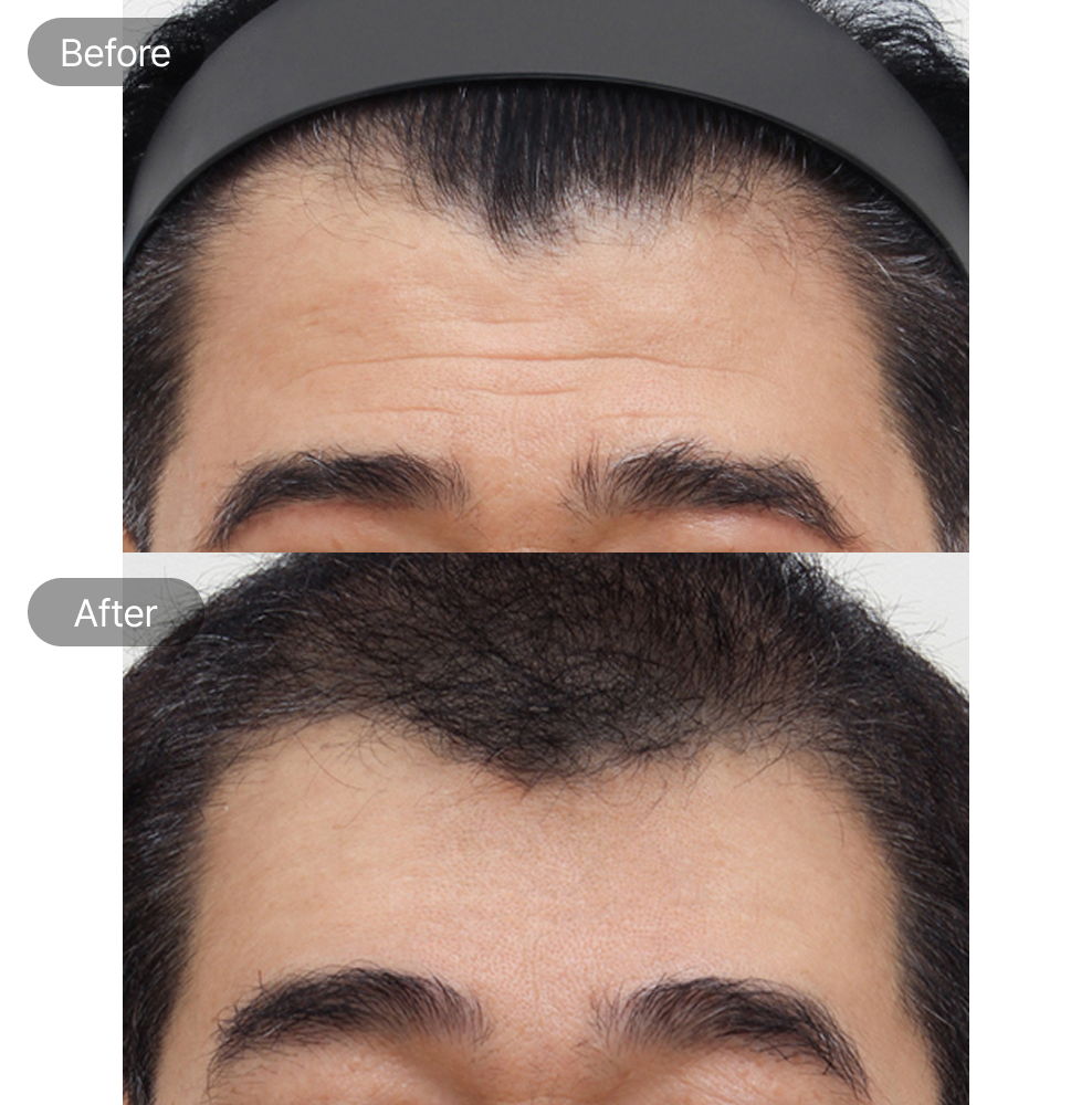 Forehead wrinkle improvement before and after results at Fresh Dr. Hong Plastic Surgery in Korea