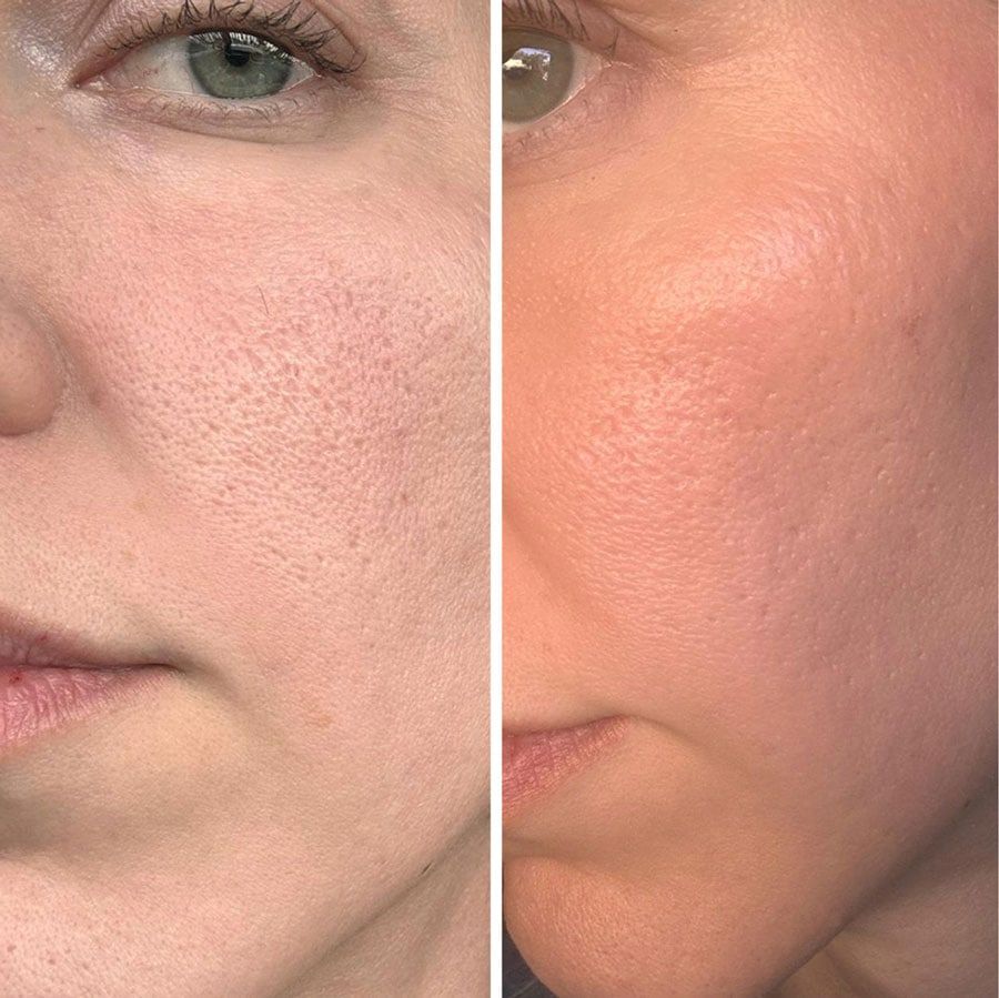 Comparison of skin texture before and after treatment.