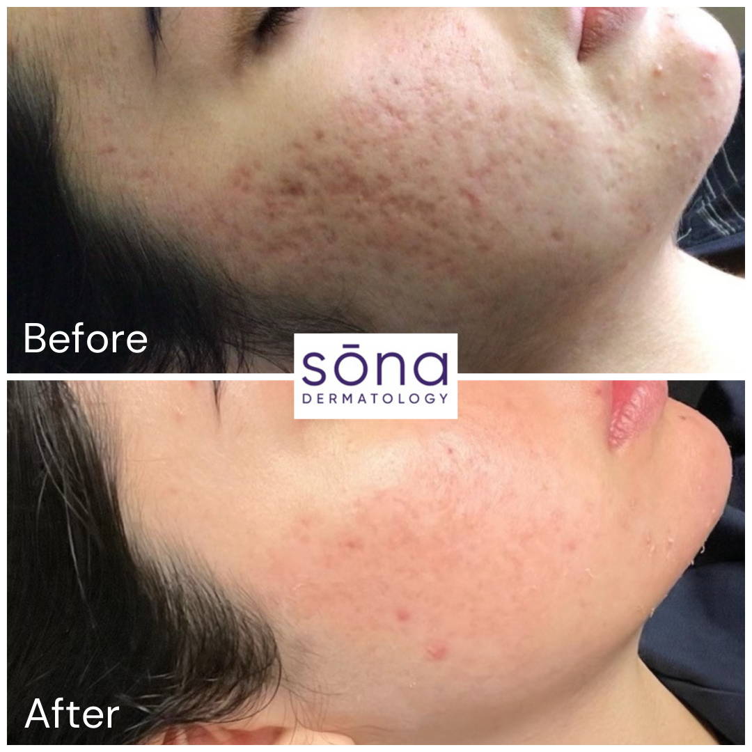 Sona SkinPen Microneedling Before & After