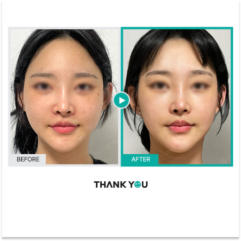 Rejuran S PDRN Injection Combined With Laser Therapy for Acne Scar Treatment and Korean Glass Skin Improvement