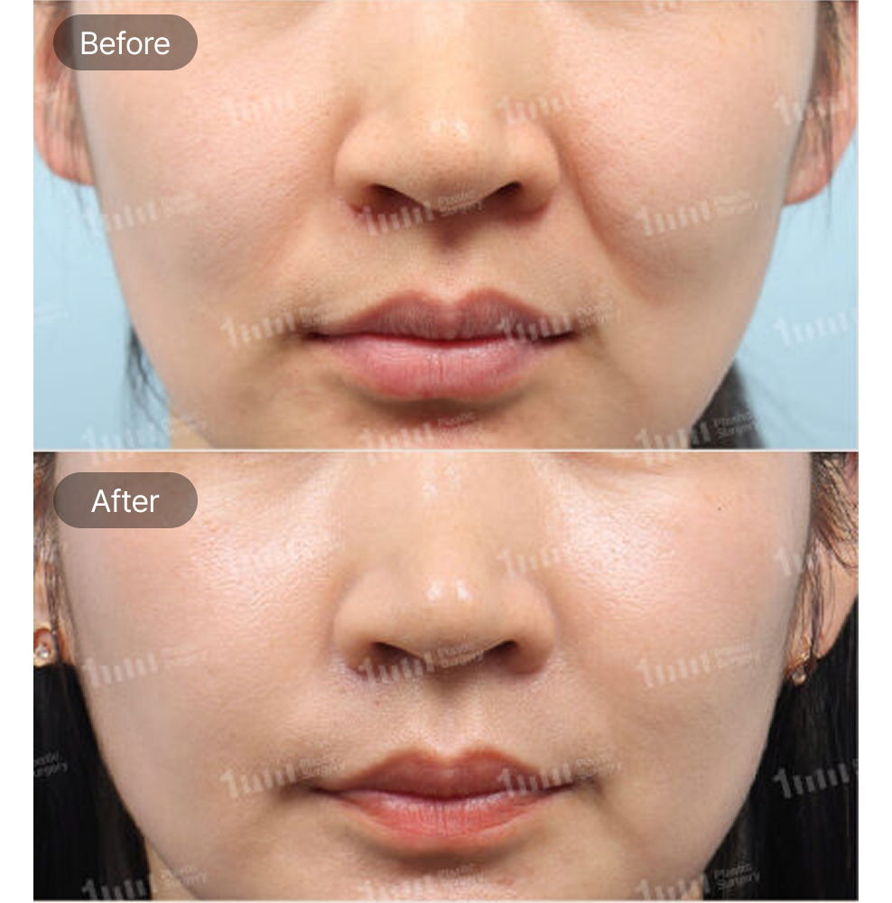 Nasolabial Fold Thread Lifting Before and After Results at 1MM Plastic Surgery in Korea for Smoother and Firmer Facial Lines