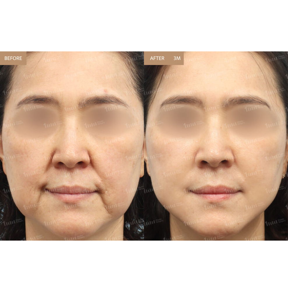 Thread Lifting and Fat Grafting Before and After Results at 1MM Plastic Surgery in Korea for Firmer and More Youthful Facial Contours