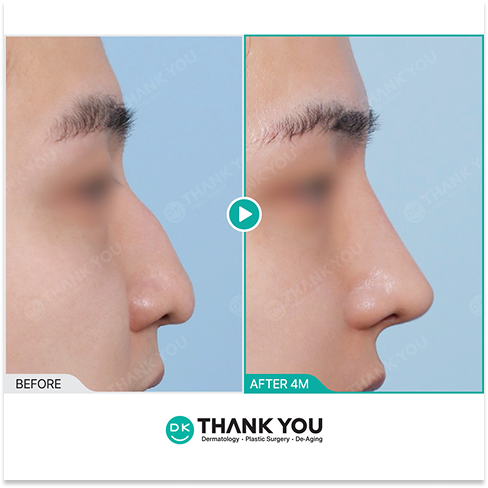 Male Rhinoplasty Korea for Natural Hump Nose Correction and Masculine Facial Balance