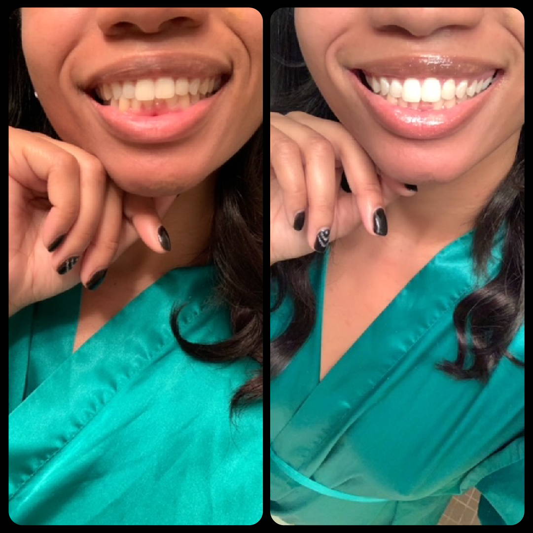 Check out these amazing teeth whitening results.