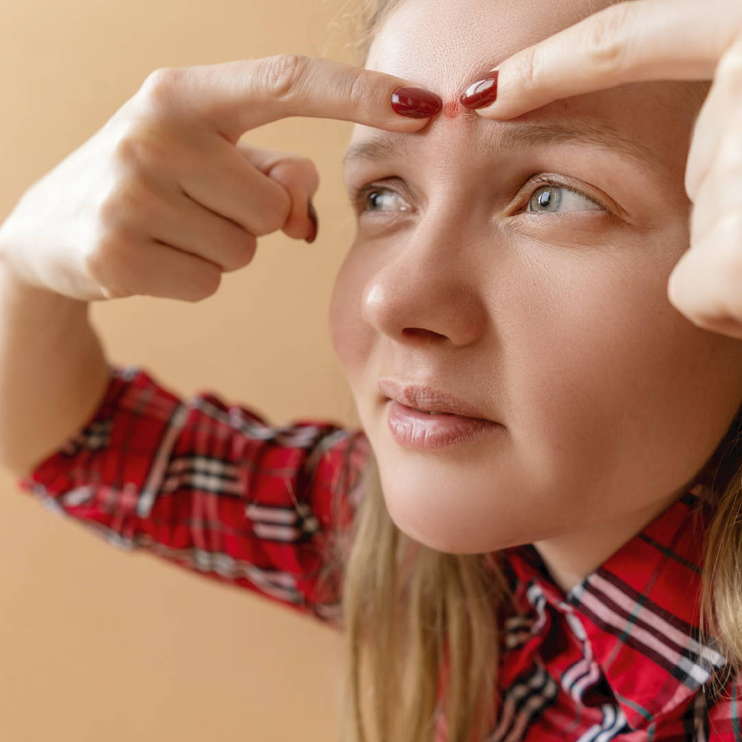 Image of a teen girl with acne on her forehead.