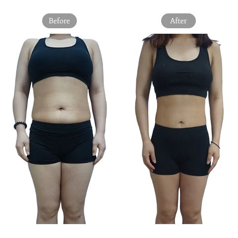 Bioface Plastic Surgery Noninvasive Liposuction Body Fat Reduction Before and After Results