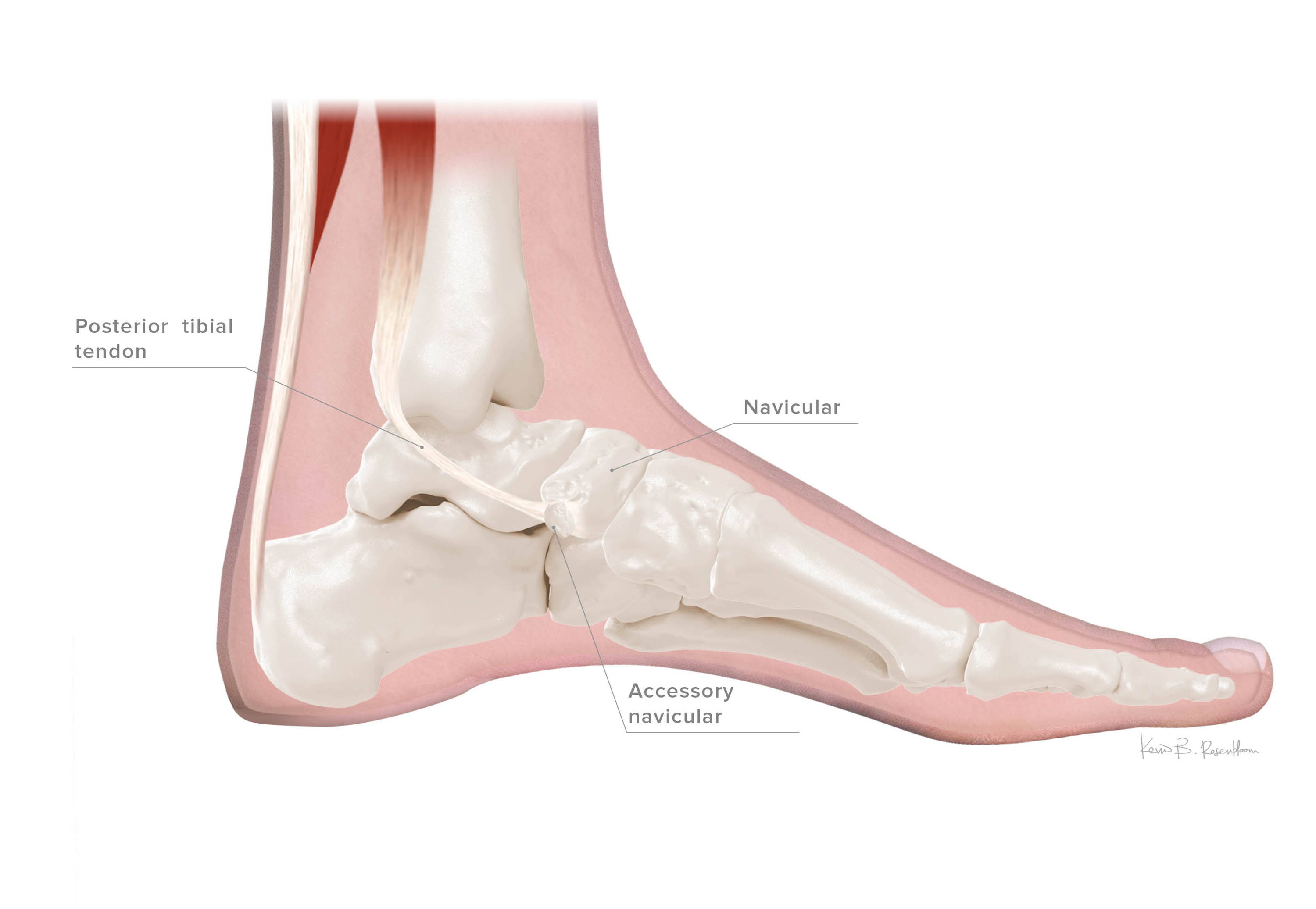 Accessory Navicular Syndrome