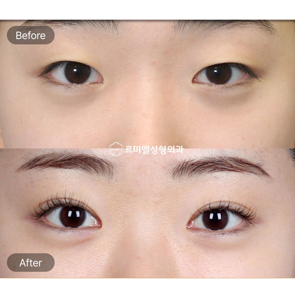 Before and After Results of Non Incisional Ptosis Correction, Epicanthoplasty, and Upper Eyelid Fat Removal After Eleven Months