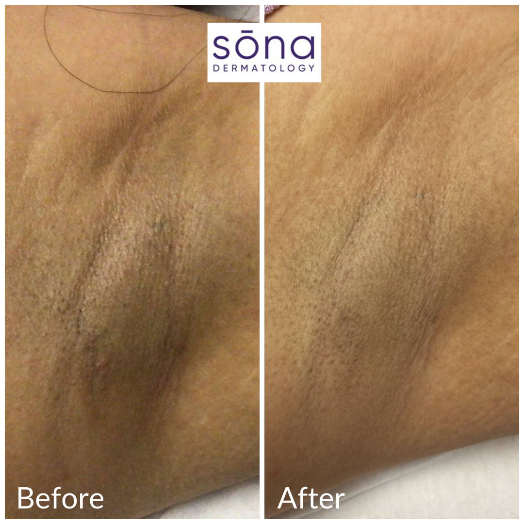 Sona Motus AY Laser Hair Removal Before & After 4