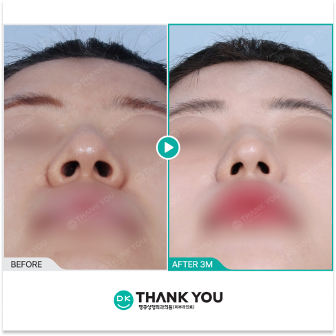 Revision rhinoplasty with alar base reduction showing narrower nostrils and improved nasal width at 3 months post op in Korea