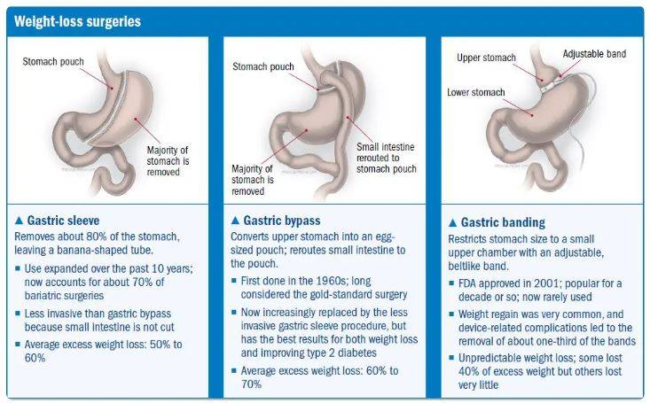 WEIGHT LOSS SURGERY