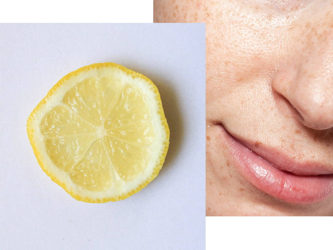 taches pigmentaires visage | Cinq soins de la peau