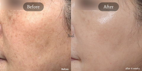 Pico Toning Korea for Korean Summer Skin Treatments Targeting Pigmentation, Sun Spots, and Facial Redness
