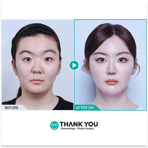 Before and After Facial Balancing in Korea Showing Facial Contouring, Facial Fat Grafting, and Thread Lift Results After 3 Months