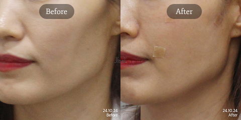 Facial volume restoration for sagging skin using Juvelook collagen stimulator, improving skin fullness and youthful contour