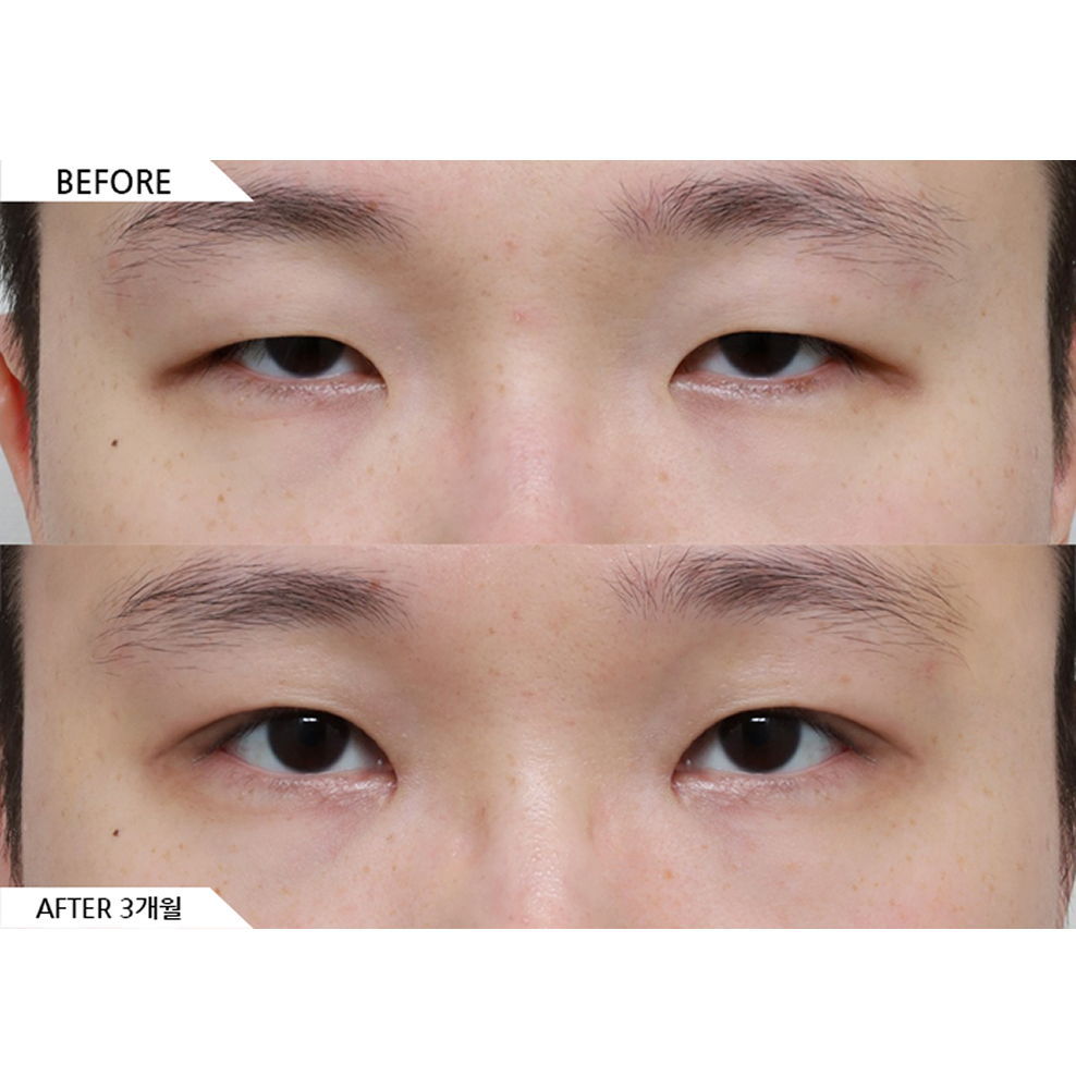 Before and after male double eyelid surgery with ptosis correction, epicanthoplasty, and lateral canthoplasty showing more defined eyes and improved eye shape 3 months after surgery in Korea