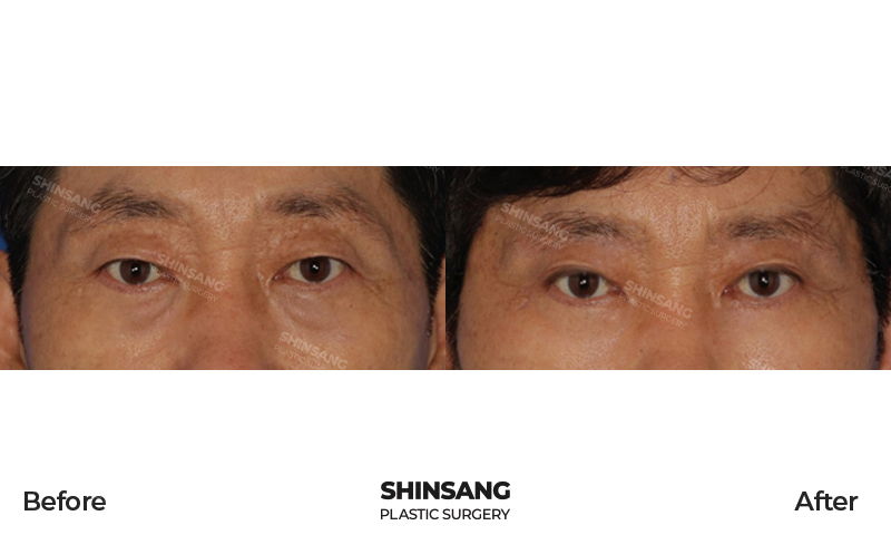 Lower Blepharoplasty And Brow Lift Result At Sinsang Plastic Surgery In Korea